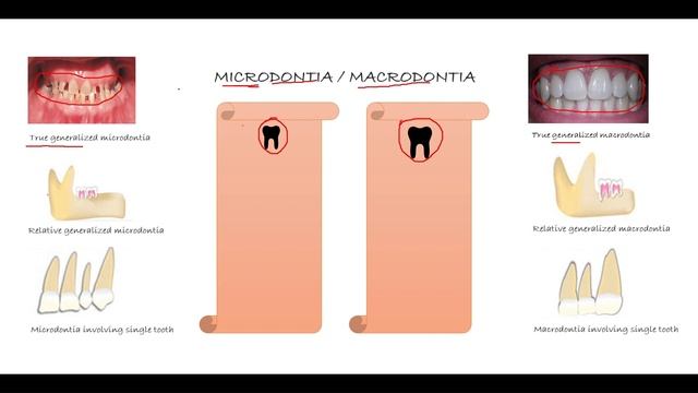 DEVELOPMENTAL DISTURBANCES IN SIZE OF TEETH - MACRO & MICRO смотреть онлайн
