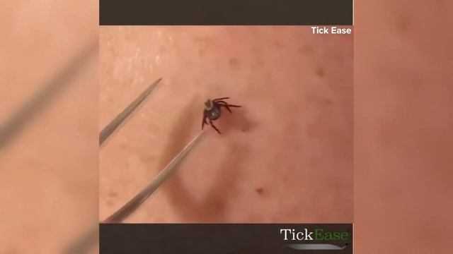 Protecting kids from tick-borne diseases смотреть онлайн