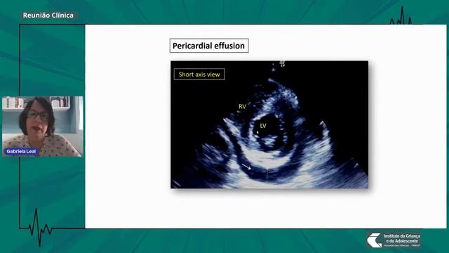 Como o ecocardiograma pode ajudar os pediatras na avaliação hemodinâmica? смотреть онлайн