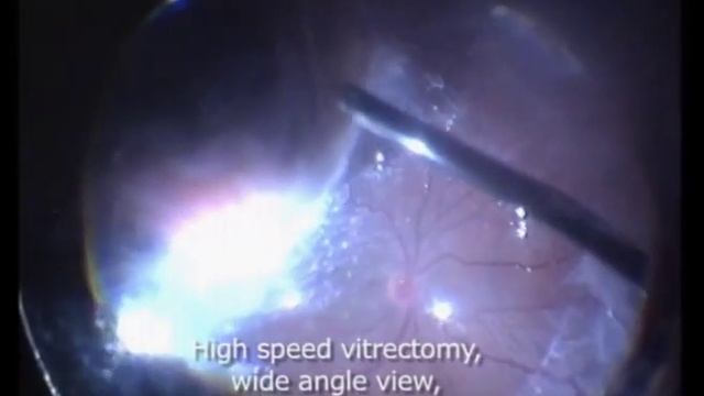 Subchoroidal hemorrhage after blunt trauma in previous PK смотреть онлайн