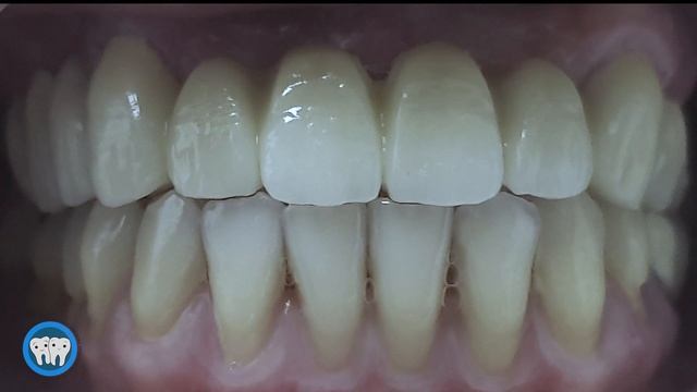Upper anterior Zirconia Bridge смотреть онлайн
