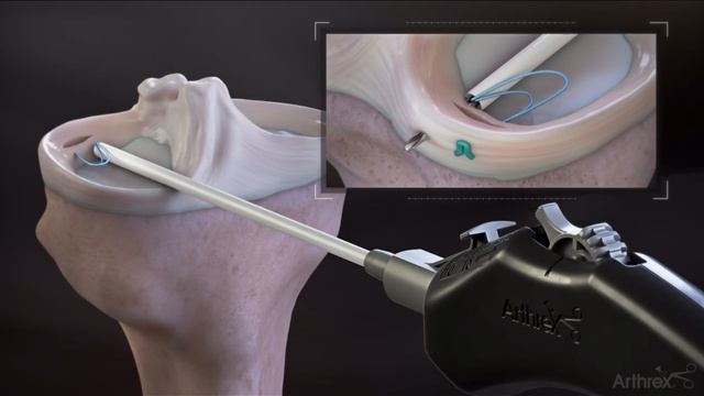 Шов мениска. Моделирование