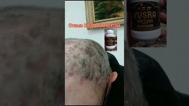 @юсро @юсра капсулы @YUSRA.05.95 ЮСРО КАПСУЛЫ ОТ РАЗЛИЧНЫХ ЗАБОЛЕВАНИЙ ОТ РАКА ОТ ПСОРИАЗА ОТ САХАР смотреть онлайн