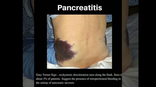 Pancreatitis!!! Gray Turner Sign!!! Dr Gohar Shahroz #baby #short #medical #doctor смотреть онлайн