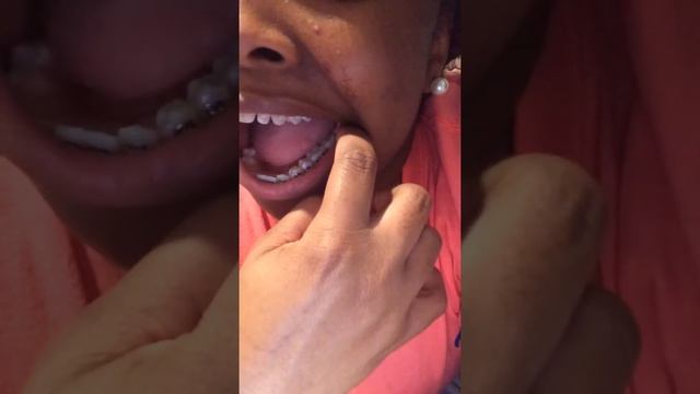 Damon Braces : Clear Top, Metal Bottom смотреть онлайн