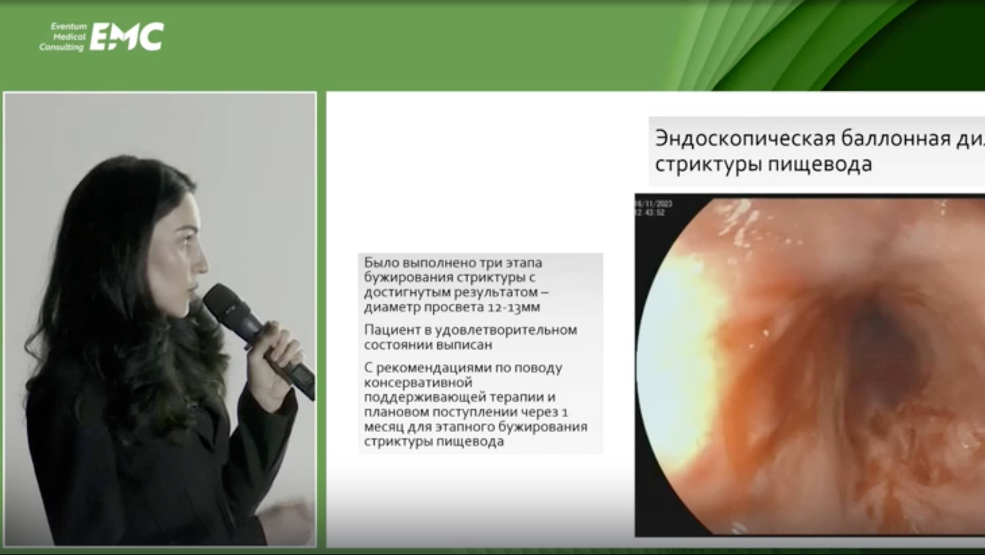 5 Магомедова БМ Доброкачественные рубцовые стриктуры пищевода: мировой опыт и опыт нашего отделения