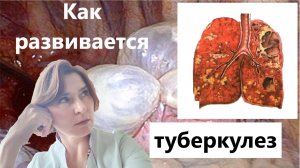 Как развивается туберкулез