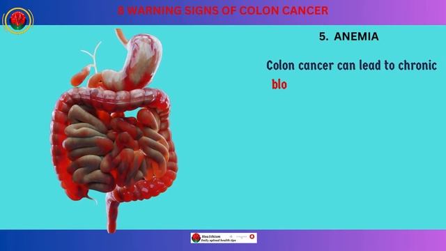 Early detection of colon cancer | Don't ignore. смотреть онлайн