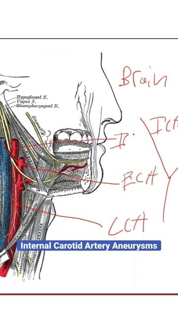 Internal Carotid Artery Aneurysm Explained смотреть онлайн
