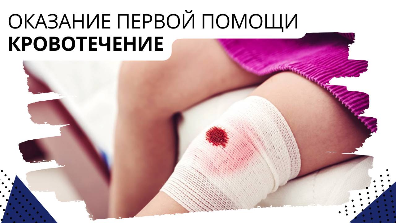 Оказание первой помощи. Кровотечение