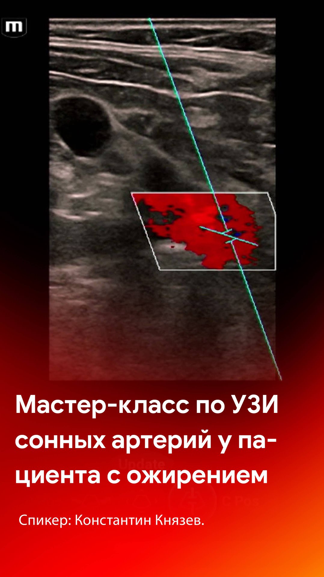 Мастер-класс по УЗИ сонных артерий у сложного пациента смотреть онлайн