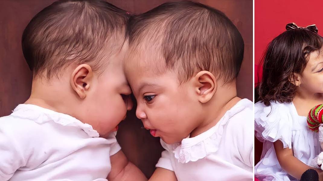 Медики совершили ЧУДО и разделили Близнецов со сросшимися головами смотреть онлайн