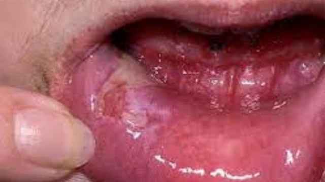 Pênfigo смотреть онлайн