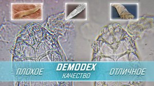 Дегтярное мыло против клеща? | Угревая Железница Demodex
