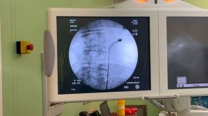 Тандемное стентирование мочеточника