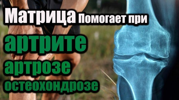 Матрица Гаряева для суставов – восстановление при артрозе, остеохондрозе и артрите!#эхотибета