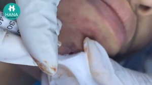 massive blackheads on nose and lips - Clean Giant Blackheads on Nose 2023 - spa - hana spa