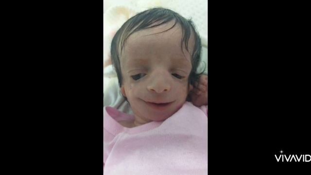 Treacher Collins Syndrome (TCS).