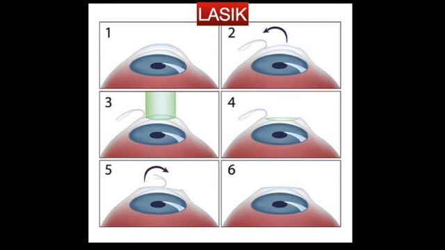 Lasik Eye Surgery-Lasik Surgeon Kolkata-Refractive Surgery смотреть онлайн