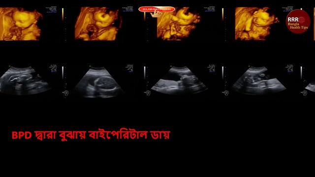 গর্ভবতী মায়ের ৭ম মাসের আল্ট্রাসনো রিপোর্ট কেমন হওয়া উচিত ? || 7months Pregnancy Ultrasound Report смотреть онлайн