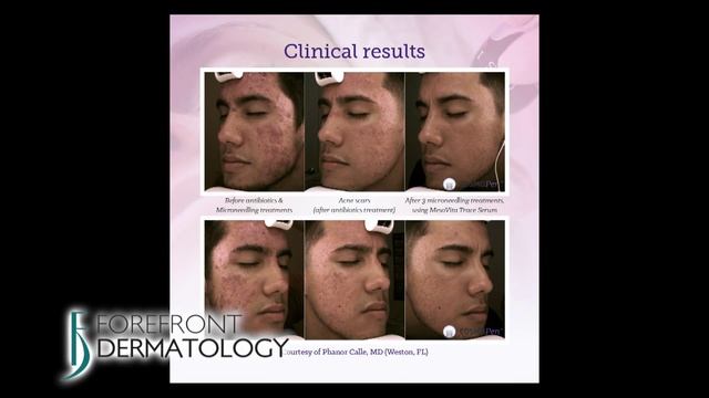 Learn about Microneedling - Forefront Dermatology смотреть онлайн
