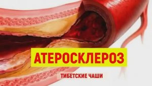АТЕРОСКЛЕРОЗ СОСУДОВ ГОЛОВЫ (СЕРДЦА)*ТИБЕТСКИЕ ЧАШИ*ИСЦЕЛЕНИЕ ЗВУКОМ
