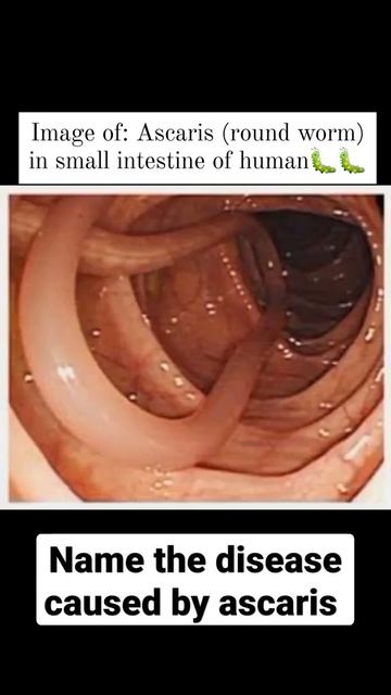 Human Health and Disease | Ascariasis | Round worm смотреть онлайн