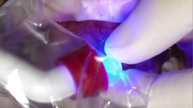 edelweiss ● Direct Venear & Composite System - Clinical Case 1 смотреть онлайн