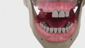 Пошаговая установка полных несъемных протезов «All-on-4»