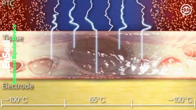 Lets Get Back to Basics: Working Principles of Vessel Sealing Devices, Ligasure, EnSeal, Thunderbea смотреть онлайн