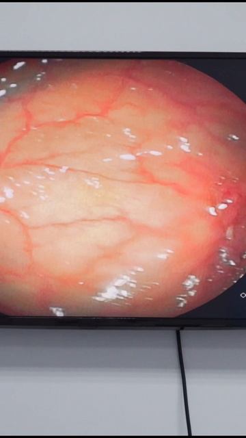 Удаление полипа