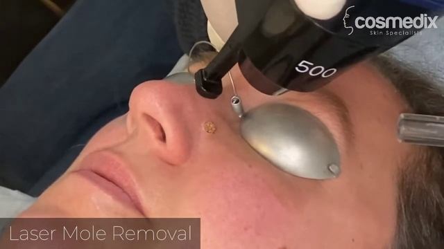 Laser Mole Removal смотреть онлайн