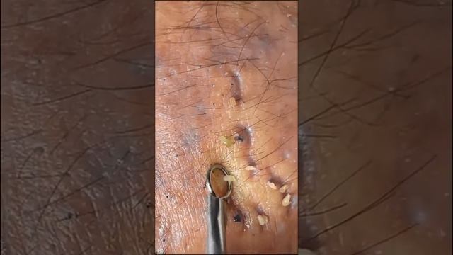 Big Cystic Acne Blackheads Extraction Blackheads & Milia, Whiteheads Removal 4