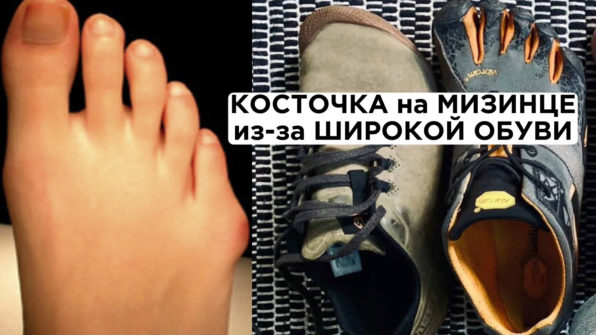 Почему появляется косточка на мизинце. Широкая обувь один из факторов смотреть онлайн