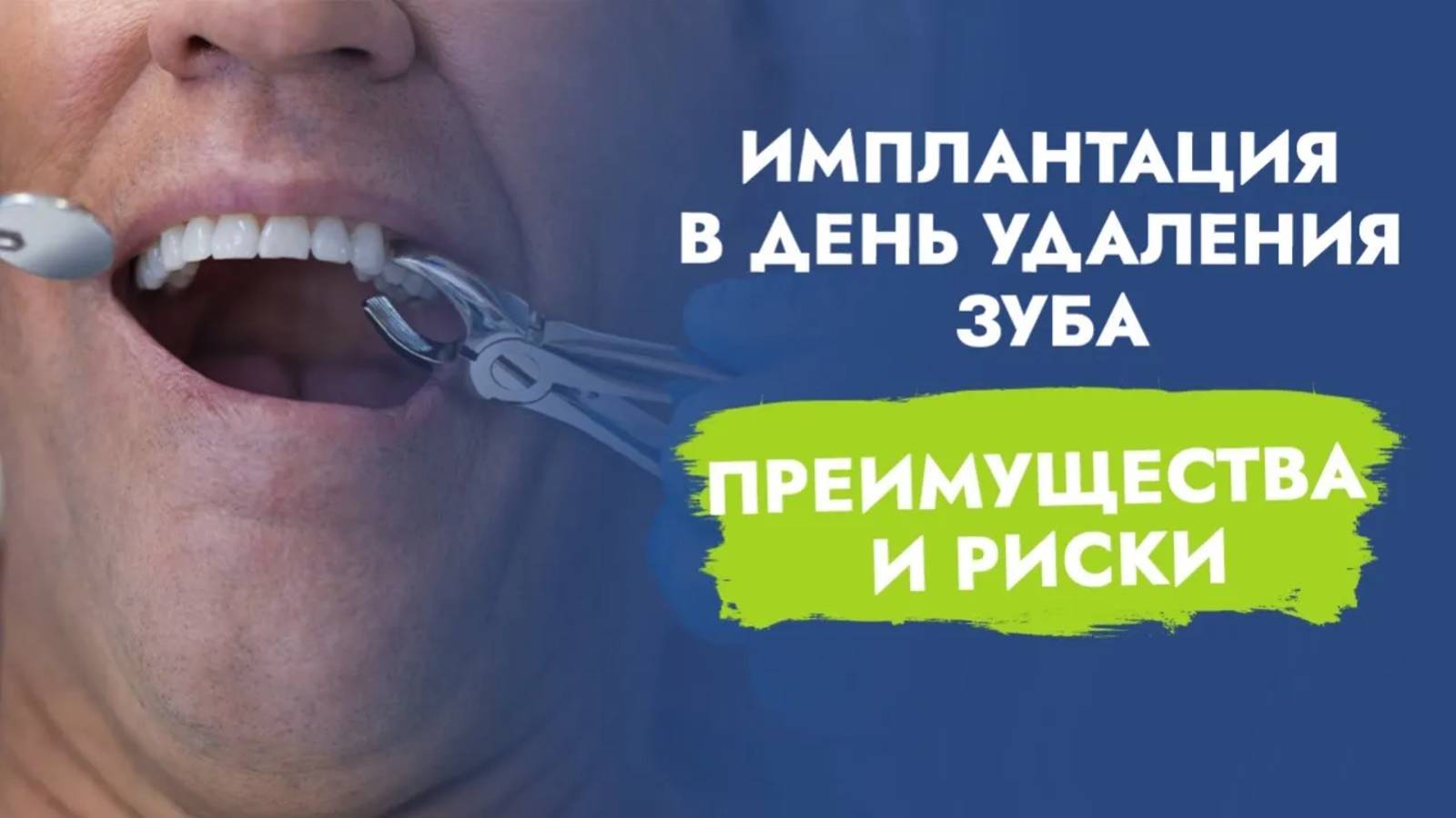 Когда имплантат можно установить в день удаления зуба?