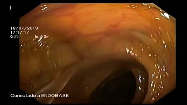 Colonic lavage during colonoscopy. смотреть онлайн