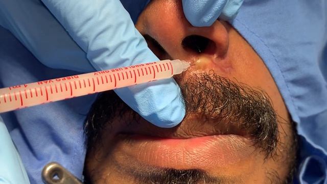 Hypertrophic Scar treatment on the face with magic injections at Richardsons Craniofacial Hospital смотреть онлайн