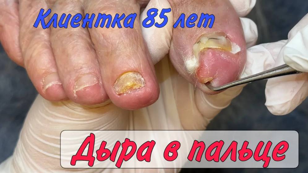 Дыра в пальце _ Вросший ноготь _ Старческие ногти смотреть онлайн