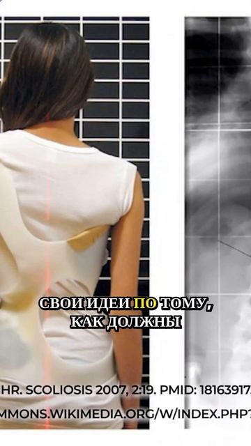 Корсет Шено при сколиозе #реабилитация #лечениесколиоза #подросток #сколиоз #травматолог #осанка смотреть онлайн