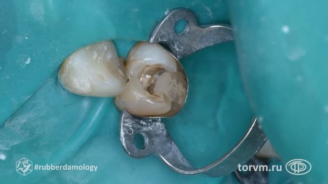 #rubberdamology TorVM Matrix Aplication 011 ENG смотреть онлайн