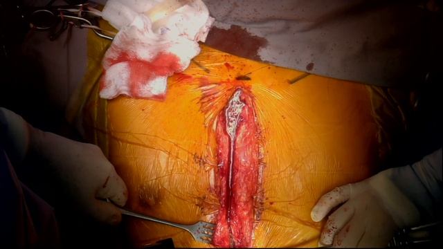 Redo Aortic Arch Replacement: Redo Sternotomy смотреть онлайн