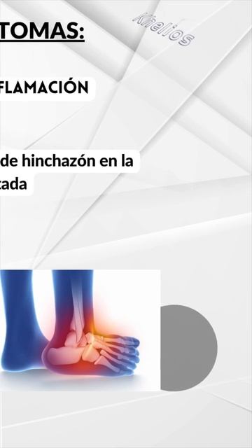 ESGUINCE TOBILLO: SÍNTOMAS #esguince #kinesiología #viñadelmar #reñaca #fisioterapia #dolor #salud смотреть онлайн