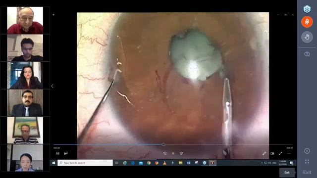IIRSI 50:50 International Cataract Webinar смотреть онлайн