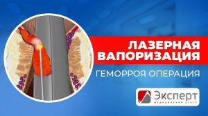 Лазерная вапоризация геморроя. Как проходит операция.