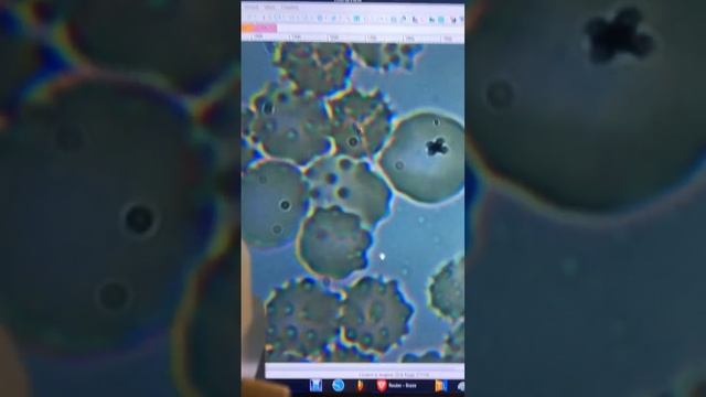 Микроскопический тест крови. Оценка. смотреть онлайн