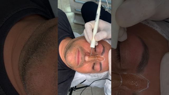 Rinomodelação Nasal, técnica para levantar a ponta do nariz com Jato de Plasma смотреть онлайн