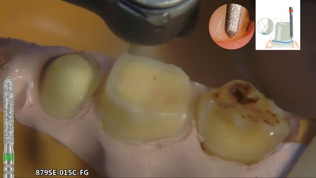 2 1 Easy Chamfer препарирование уступа смотреть онлайн