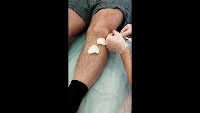 Плазмолифтинг коленного сустава смотреть онлайн