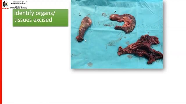 20200720 UKZN Final Year Lecture Bowel Obstruction смотреть онлайн