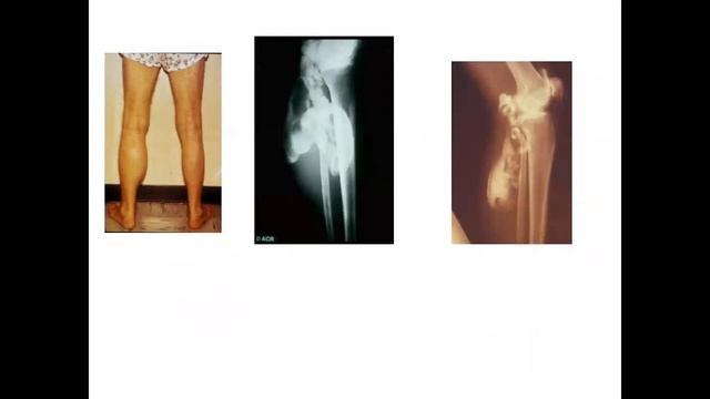 Ревматоидный артрит. Патогенез.